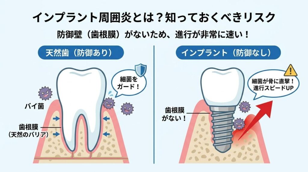 インプラント周囲炎とは？知っておくべきリスクと原因